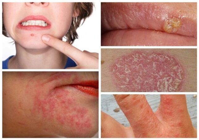 Allergies and skin diseases are signs of parasites in the body