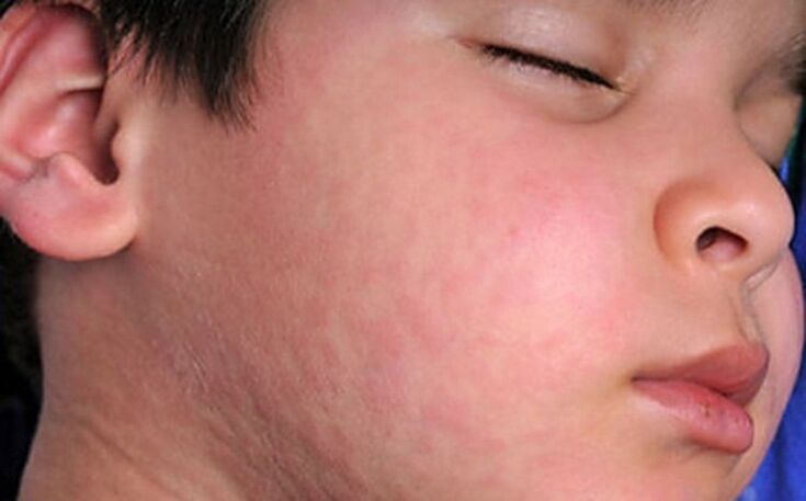 Allergic rashes on the skin - a symptom of the presence of parasitic worms in the body