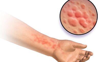 Manifestations of schistosomosis in humans